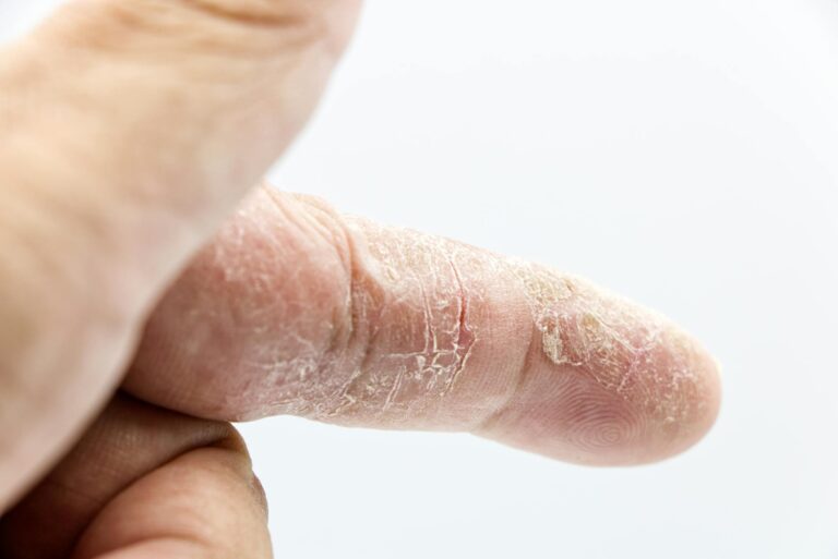 Closing the dermatology divide: Eczema care solutions for communities of color - Featured image